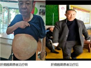 治疗各种癌症无效不收费广西百色杨忠雅医师