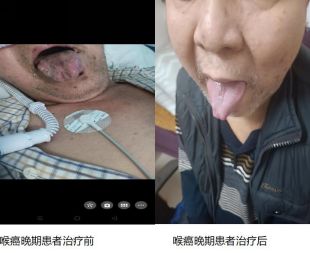 治疗各种癌症无效不收费广西百色杨忠雅医师